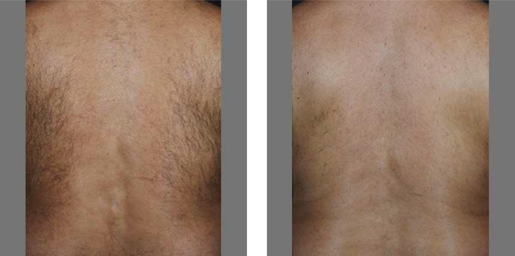 laser hair removal before after laser hair removal before after