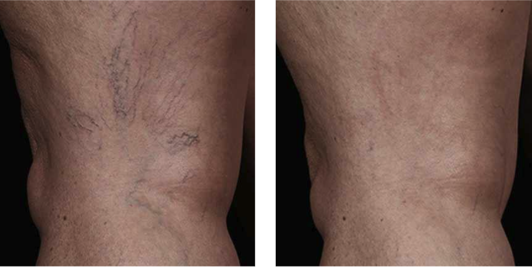 laser vein removal before after