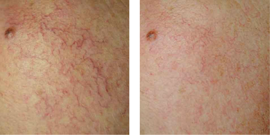 laser vein removal before after