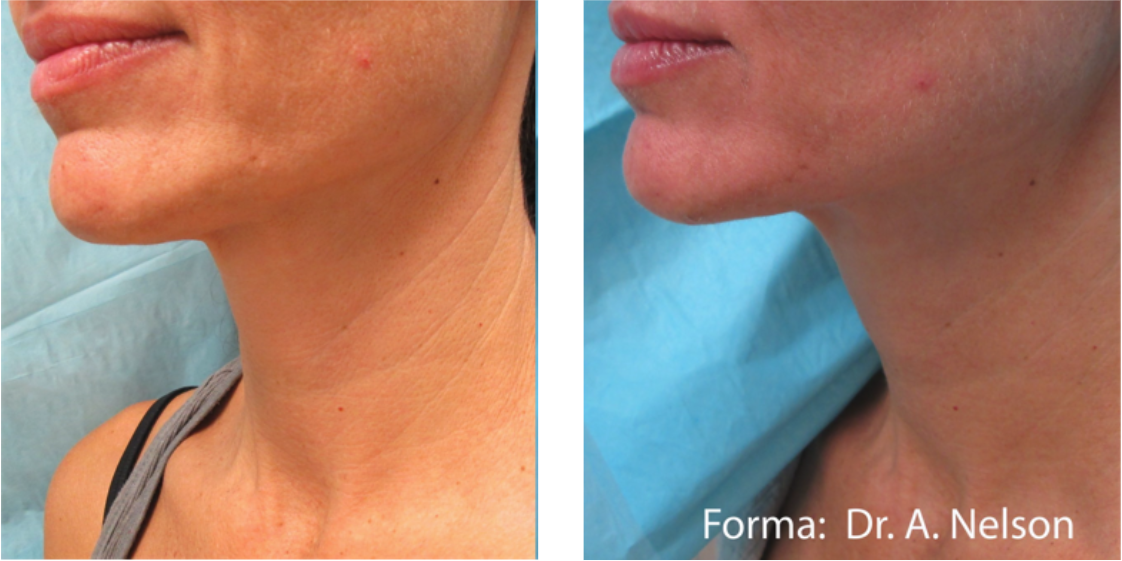 skin tightening before after