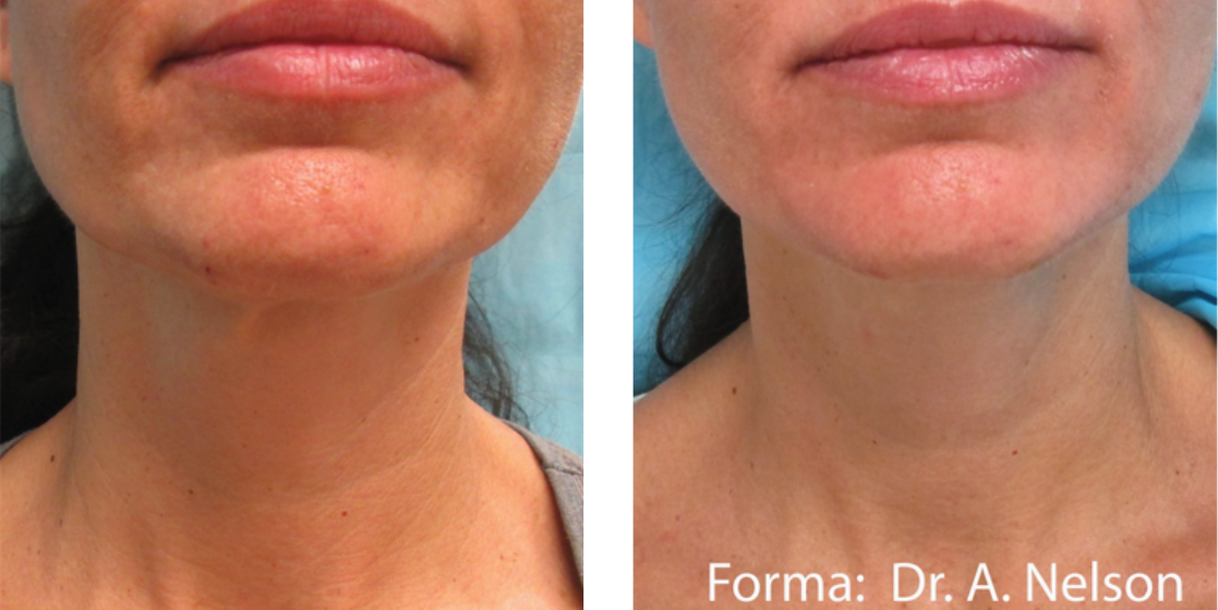 skin tightening before after