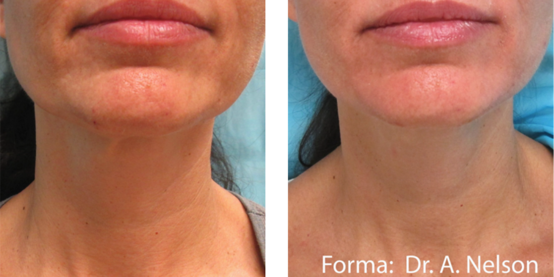 Forma Facial Skin Tightening NYC