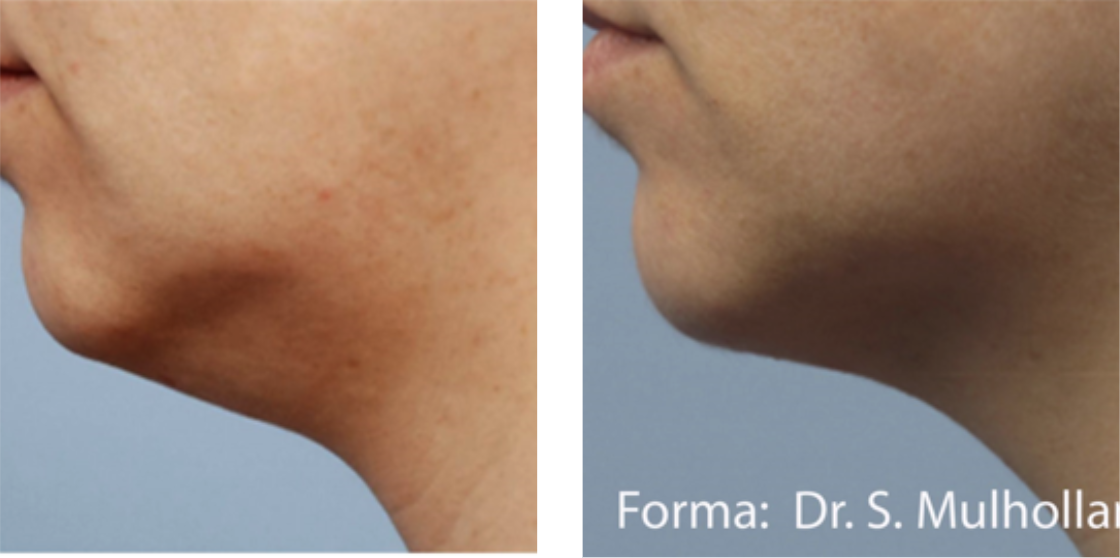 skin tightening before after