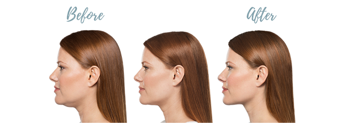 Kybella before and after results