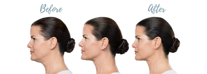 Kybella before and after results