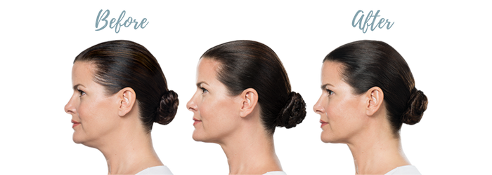 Kybella before and after results