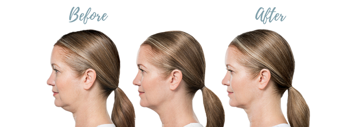 Kybella before and after results