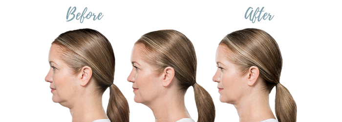 Kybella before and after results