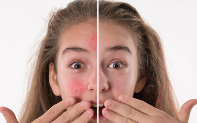 Unmasking the Secrets of Acne Treatment: Tribeca Medspa’s Comprehensive Guide