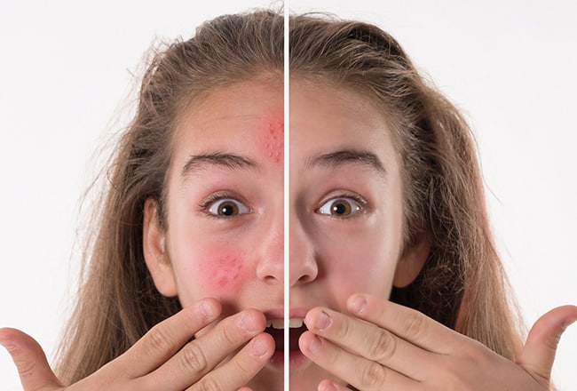 acne teenage girl