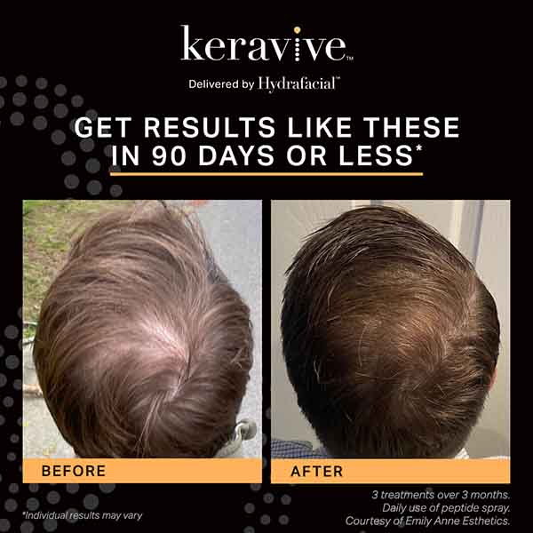 Keravive Before and After Results
