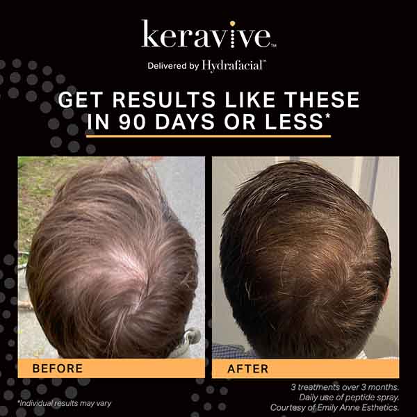 Keravive Before and After Results Keravive Before and After Results