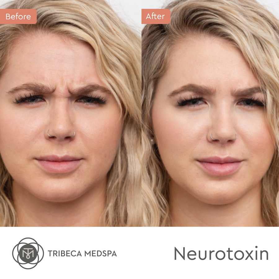 Neurotoxin treatment before and after results
