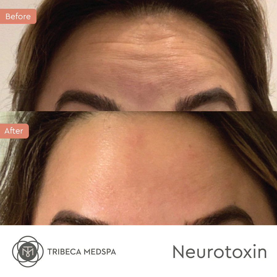 Before and after neurotoxin treatment on the forehead