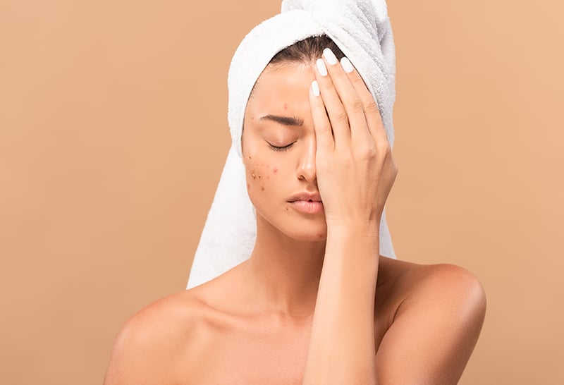Close-up of a woman with acne, feeling insecure