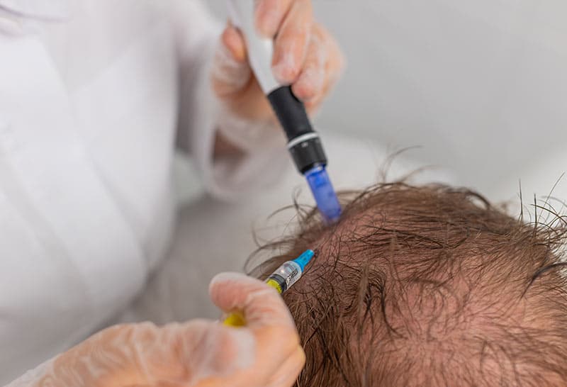 Medical procedure for hair loss treatment. Medical procedure for hair loss treatment.